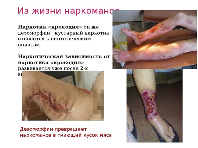 Из жизни наркоманов Наркотик «крокодил»  он же дезоморфин - кустарный наркотик относится к синтетическим опиатам.   Наркотическая зависимость от наркотика «крокодил» развивается уже после 2-х внутривенных инъекций. Дезоморфин превращает наркоманов в гниющий кусок мяса 