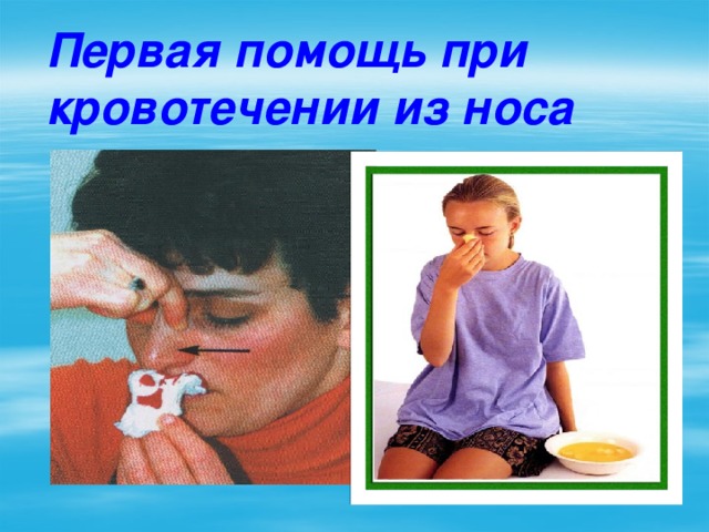 Первая помощь при кровотечении из носа 