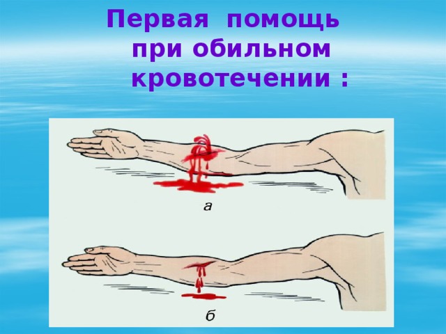 Первая помощь  при обильном  кровотечении : 