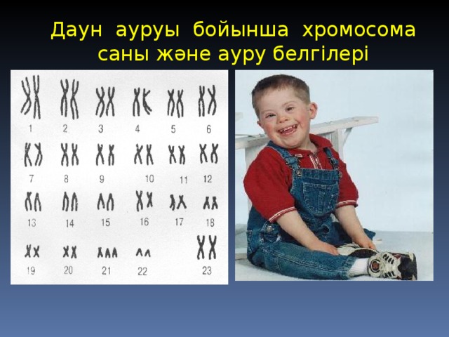 Даун ауруы бойынша хромосома саны және ауру белгілері 