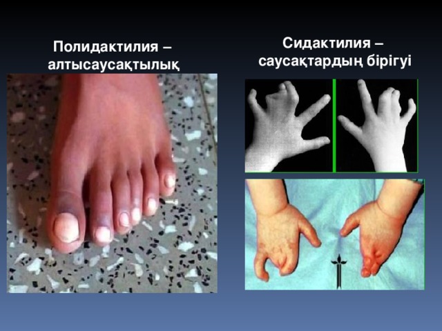 Сидактилия – саусақтардың бірігуі  Полидактилия – алтысаусақтылық 