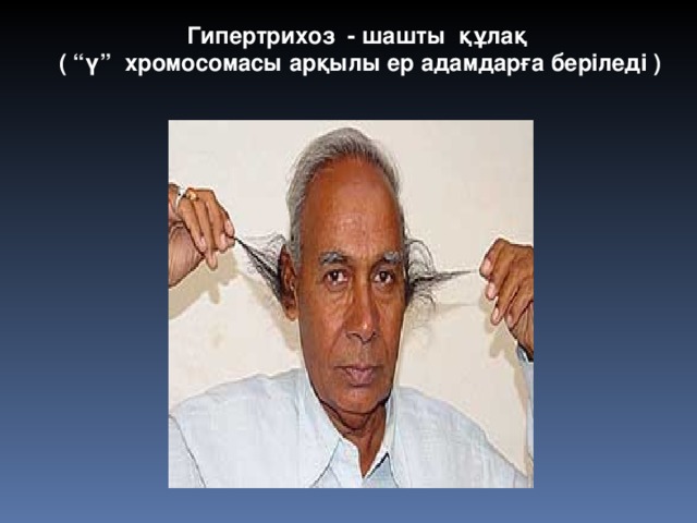 Гипертрихоз - шашты құлақ ( “ү” хромосомасы арқылы ер адамдарға беріледі ) 