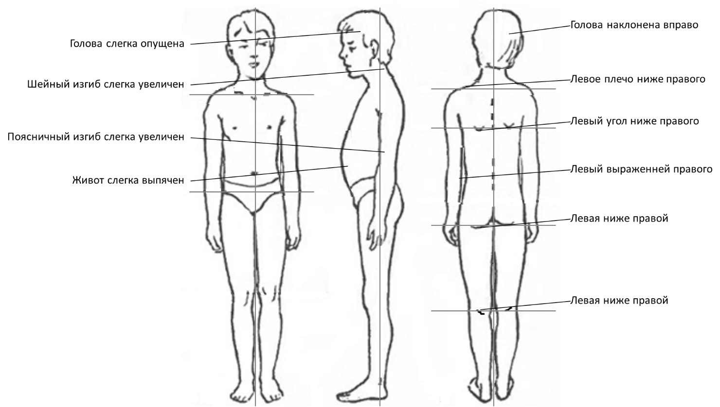 Левое ниже правого. Правильная осанка схема. Рисунок осанки в плоскостях. Осанка вид сбоку и спереди. Осанка в сагиттальной полости.