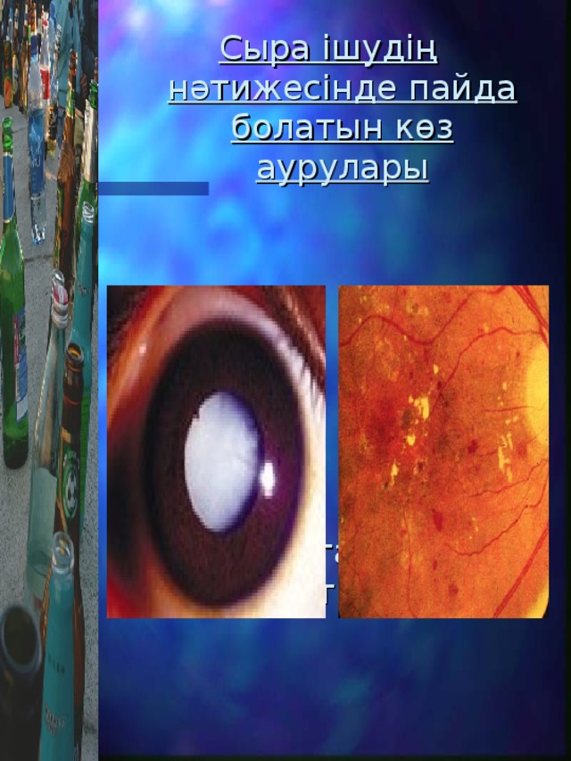 Сыра ішудің нәтижесінде пайда болатын көз аурулары  катаракта макулопатия 