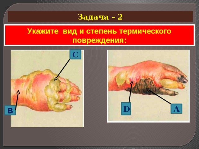 Задача - 2 Укажите вид и степень термического повреждения: C  D A  B  