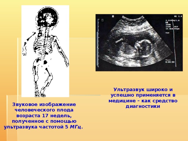 Ультразвук широко и успешно применяется в медицине – как средство диагностики    Звуковое изображение человеческого плода возраста 17 недель, полученное с помощью ультразвука частотой 5 МГц .  