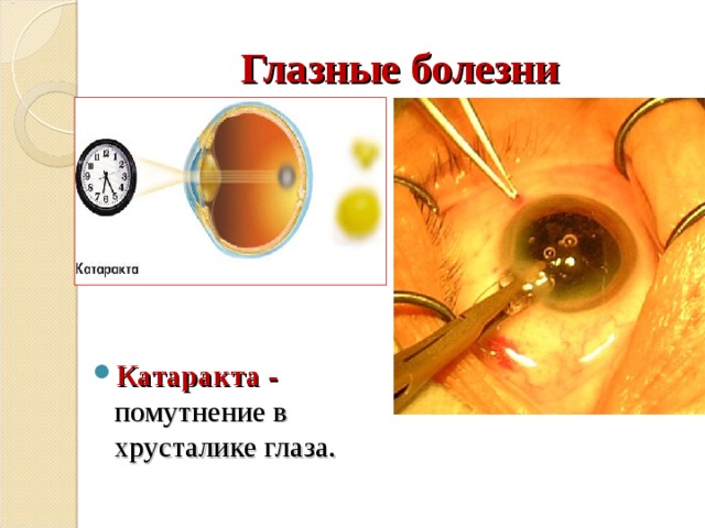 Глазные болезни Катаракта - помутнение в хрусталике глаза. 