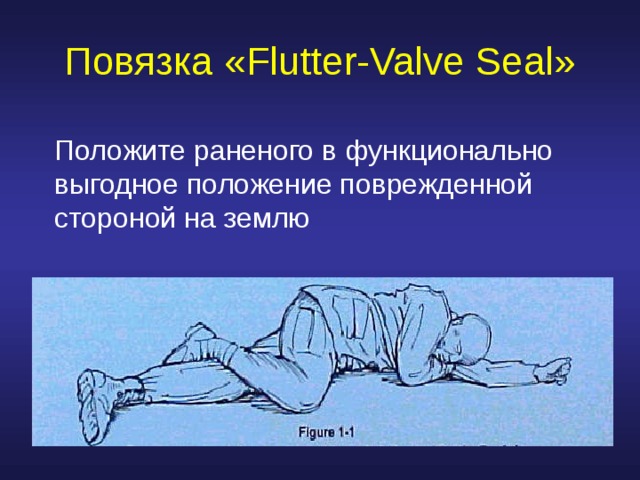 Повязка « Flutter-Valve Seal » Положите раненого в функционально выгодное положение поврежденной стороной на землю 