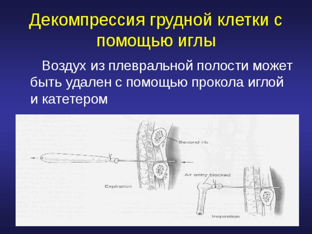 Декомпрессия грудной клетки с помощью иглы   Воздух из плевральной полости может быть удален с помощью прокола иглой и катетером 