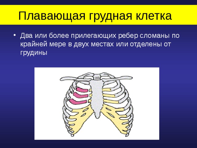 Плавающая грудная клетка  Два или более прилегающих ребер сломаны по крайней мере в двух местах или отделены от грудины 