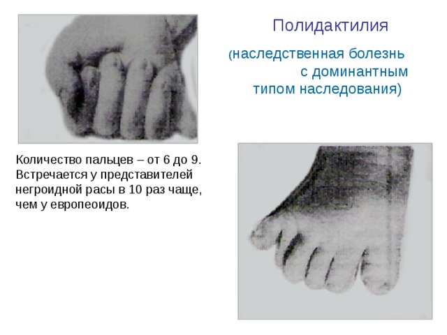 Полидактилия  ( наследственная болезнь с доминантным типом наследования) Количество пальцев – от 6 до 9. Встречается у представителей негроидной расы в 10 раз чаще, чем у европеоидов. 