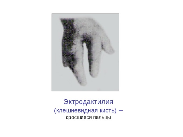 Эктродактилия (клешневидная кисть) – сросшиеся пальцы 