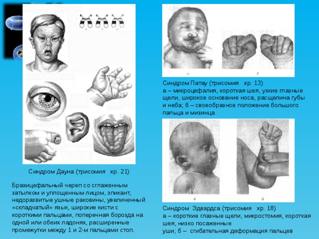 Синдром Патау (трисомия хр. 13) а – микроцефалия, короткая шея, узкие глазные щели, широкое основание носа, расщелина губы и неба; б – своеобразное положение большого пальца и мизинца Синдром Дауна (трисомия хр. 21) Брахицефальный череп со сглаженным затылком и уплощенным лицом, эпикант, недоразвитые ушные раковины, увеличенный «складчатый» язык, широкие кисти с короткими пальцами, поперечная борозда на одной или обеих ладонях, расширенные промежутки между 1 и 2-м пальцами стоп. Синдром Эдвардса (трисомия хр. 18) а – короткие глазные щели, микростомия, короткая шея, низко посаженные уши; б – сгибательная деформация пальцев