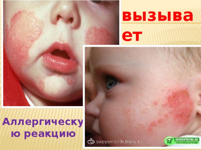 Аллергическую реакцию вызывает 