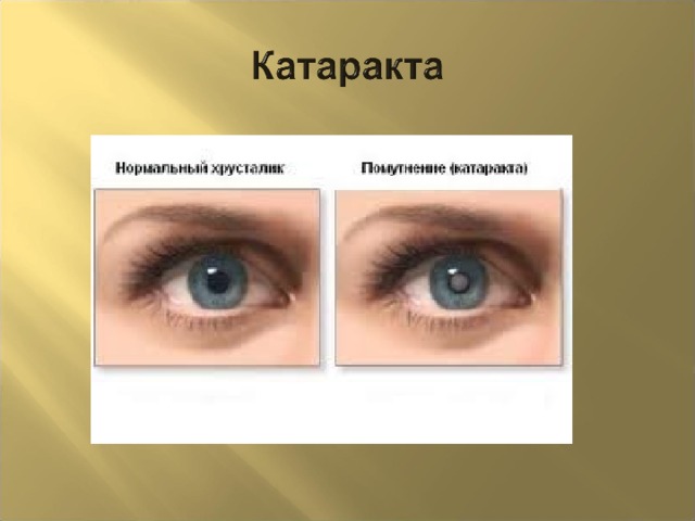 Глаукома 