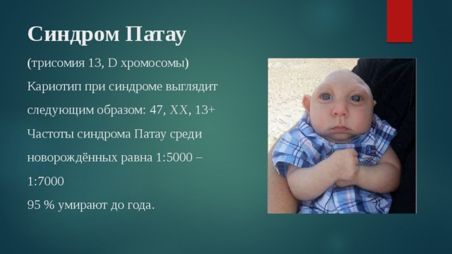 Синдром Патау (трисомия 13, D хромосомы)  Кариотип при синдроме выглядит следующим образом: 47, XX, 13+  Частоты синдрома Патау среди новорождённых равна 1:5000 –  1:7000  95 % умирают до года. 