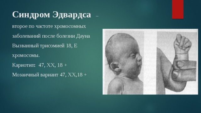 Синдром Эдвардса  – второе по частоте хромосомных заболеваний после болезни Дауна  Вызванный трисомией 18, E хромосомы.  Кариотип: 47, XX, 18 +  Мозаичный вариант 47, XX,18 +    