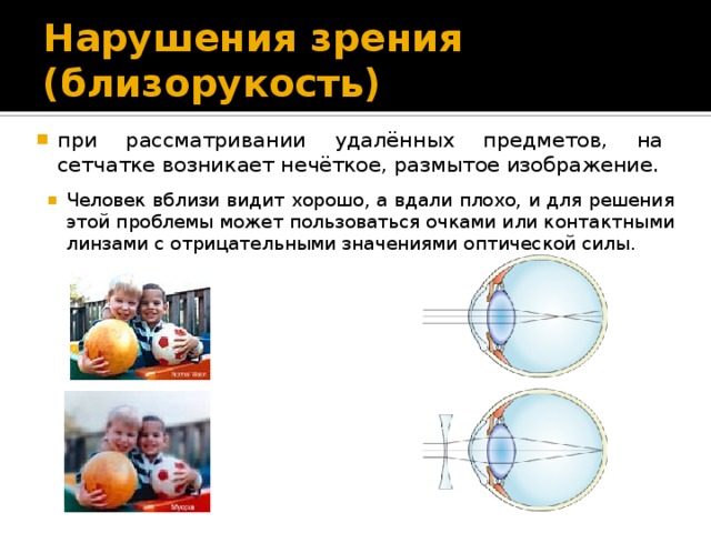 При близорукости наблюдается расплывание изображения удаленных предметов