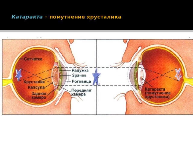 Задняя капсула