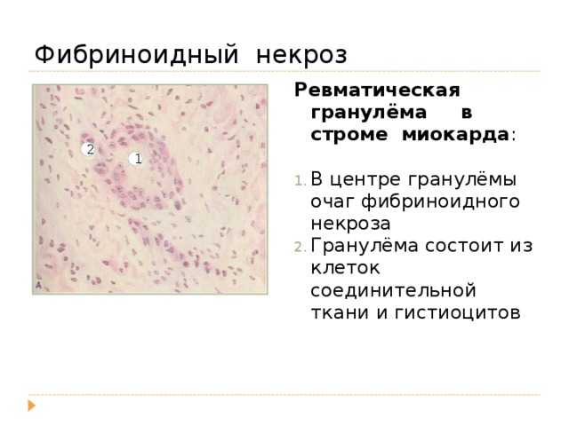 Фибриноидное набухание это. Фибриноидный некроз соединительной ткани. Гистиоциты соединительной ткани. Фибриноидный некроз сосудов. Клетки соединительной ткани гистиоциты.