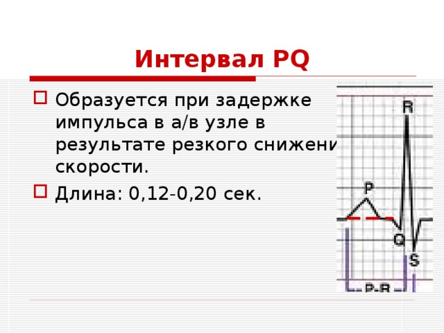 Интервал PQ Образуется при задержке импульса в а/в узле в результате резкого снижения скорости. Длина: 0,12-0,20 сек. 