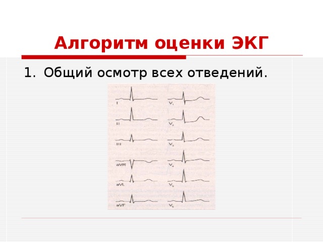 Алгоритм оценки ЭКГ Общий осмотр всех отведений. 