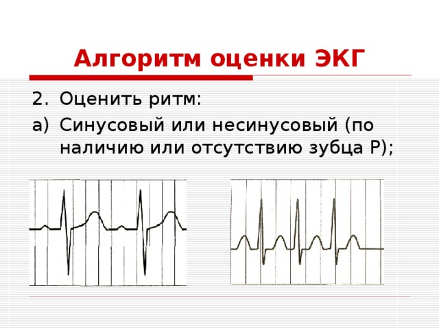 Алгоритм оценки ЭКГ Оценить ритм: Синусовый или несинусовый (по наличию или отсутствию зубца Р); 