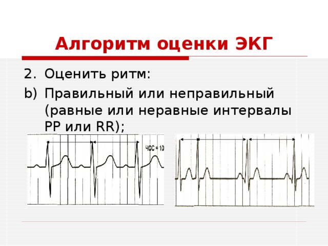 Алгоритм оценки ЭКГ Оценить ритм: Правильный или неправильный (равные или неравные интервалы РР или RR); 