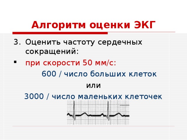 Алгоритм оценки ЭКГ Оценить частоту сердечных сокращений: при скорости 50 мм/с:  600 / число больших клеток или 3000 / число маленьких клеточек 