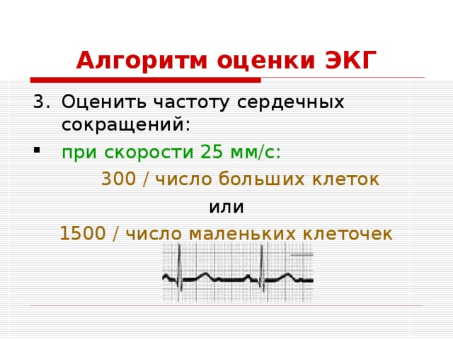 Алгоритм оценки ЭКГ Оценить частоту сердечных сокращений: при скорости 25 мм/с:  300 / число больших клеток или 1500 / число маленьких клеточек 