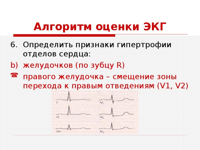 Алгоритм оценки ЭКГ Определить признаки гипертрофии отделов сердца: желудочков (по зубцу R) правого желудочка – смещение зоны перехода к правым отведениям (V1, V2) 