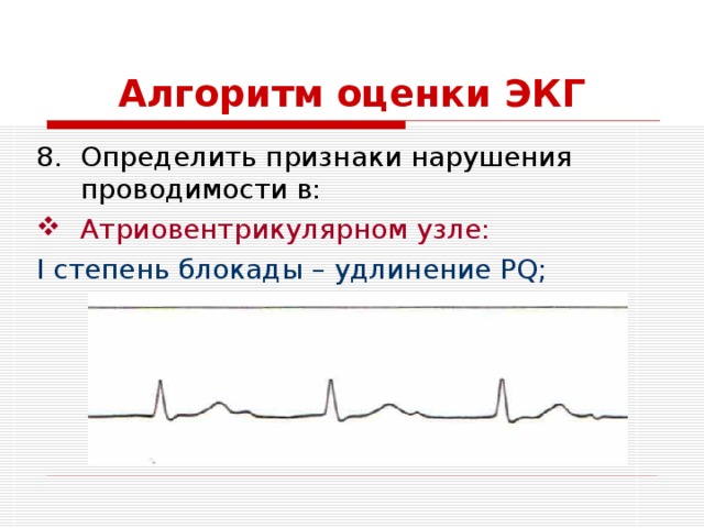 Алгоритм оценки ЭКГ Определить признаки нарушения проводимости в: Атриовентрикулярном узле: I степень блокады – удлинение PQ; 
