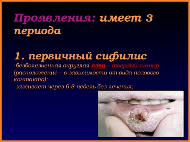 Проявления: имеет  3 периода   1. первичный сифилис  -безболезненная округлая язва – твердый шанкр (расположение – в зависимости от вида полового контакта);  заживает через 6-8 недель без лечения;   