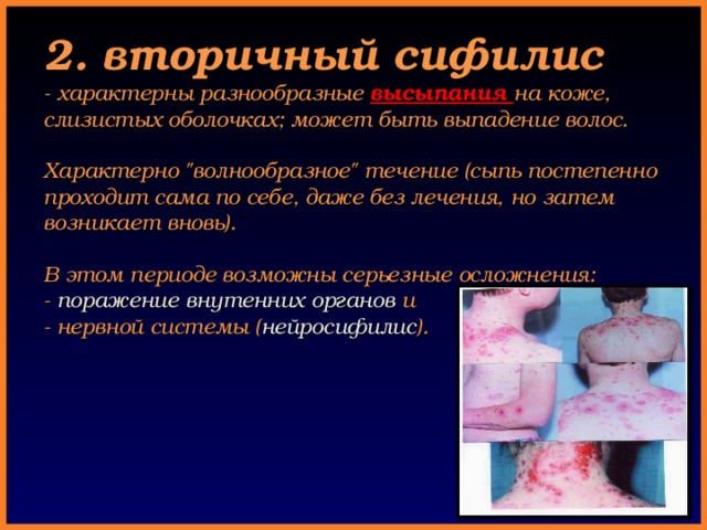  2. вторичный сифилис  - характерны разнообразные высыпания на коже,  слизистых оболочках; может быть выпадение волос.   Характерно 