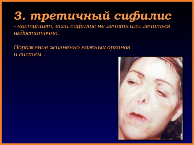  3. третичный сифилис  - наступает, если сифилис не лечить или лечиться  недостаточно.   Поражение жизненно важных органов  и систем . 