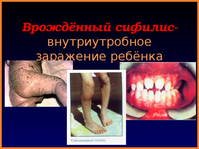 Врождённый сифилис-  внутриутробное заражение ребёнка 