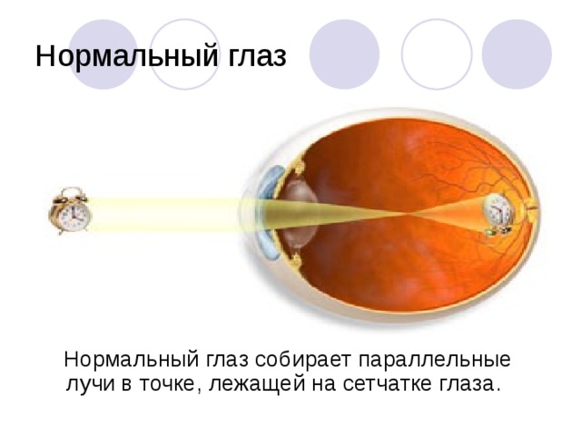 Нормальный глаз  Нормальный глаз собирает параллельные лучи в точке, лежащей на сетчатке глаза.