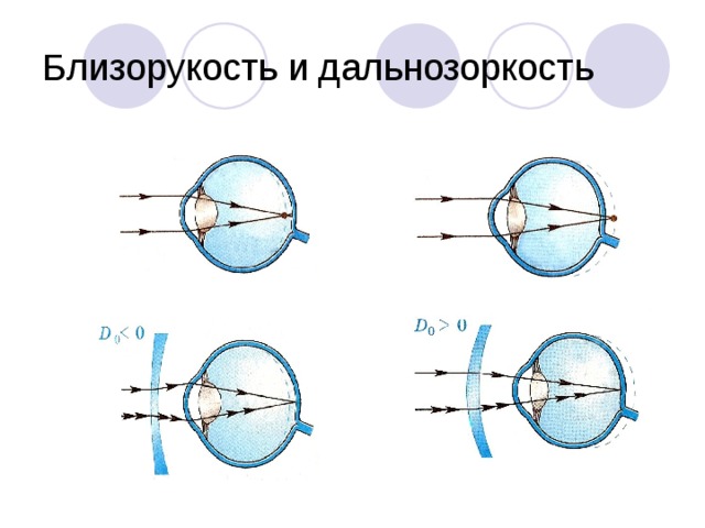 Близорукость и дальнозоркость картинки