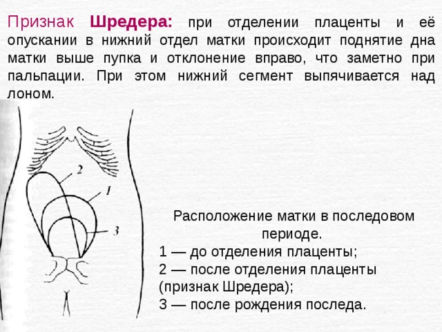 Признак Шредера:  при отделении плаценты и её опускании в нижний отдел матки происходит поднятие дна матки выше пупка и отклонение вправо, что заметно при пальпации. При этом нижний сегмент выпячивается над лоном. Расположение матки в последовом периоде. 1 — до отделения плаценты; 2 — после отделения плаценты (признак Шредера); 3 — после рождения последа.   