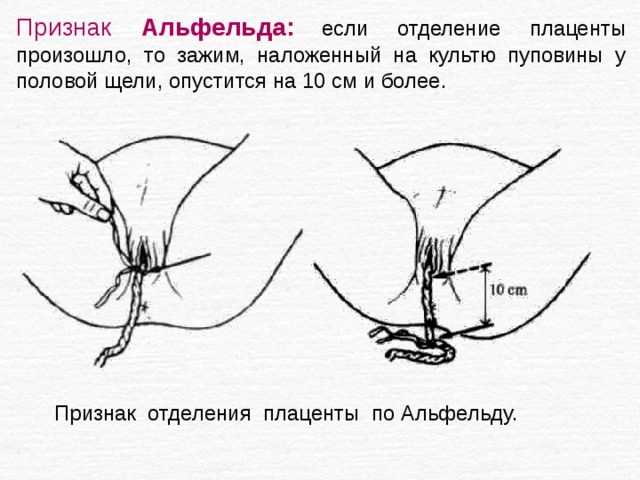 Признак Альфельда:  если отделение плаценты произошло, то зажим, наложенный на культю пуповины у половой щели, опустится на 10 см и более. Признак отделения плаценты по Альфельду.   