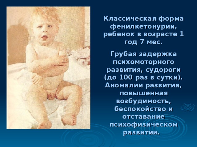 Дети с фенилкетонурией как выглядят Наследственные болезни человека - ГЕННЫЕ БОЛЕЗНИ