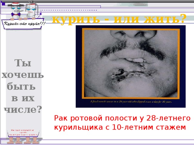 курить - или жить? Ты хочешь быть в их числе? Рак ротовой полости у 28-летнего курильщика с 10-летним стажем 