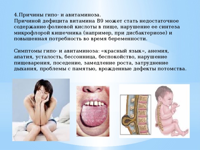 4.Причины гипо- и авитаминоза. Причиной дефицита витамина В9 может стать недостаточное содержание фолиевой кислоты в пище, нарушение ее синтеза микрофлорой кишечника (например, при дисбактериозе) и повышенная потребность во время беременности. Симптомы гипо- и авитаминоза: «красный язык», анемия, апатия, усталость, бессонница, беспокойство, нарушение пищеварения, поседение, замедление роста, затруднение дыхания, проблемы с памятью, врожденные дефекты потомства. 