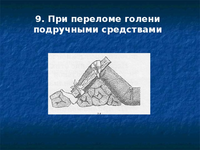 9. При переломе голени подручными средствами 