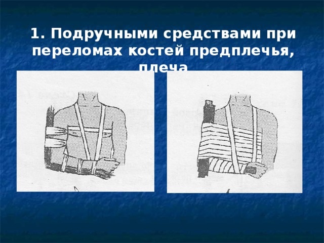 1. Подручными средствами при переломах костей предплечья, плеча 