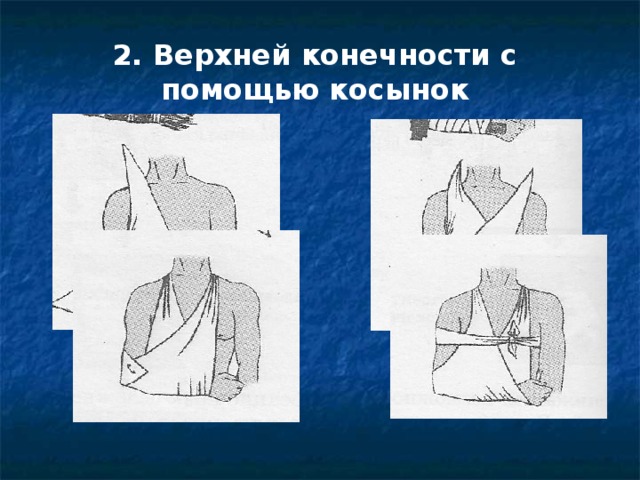 2. Верхней конечности с помощью косынок 