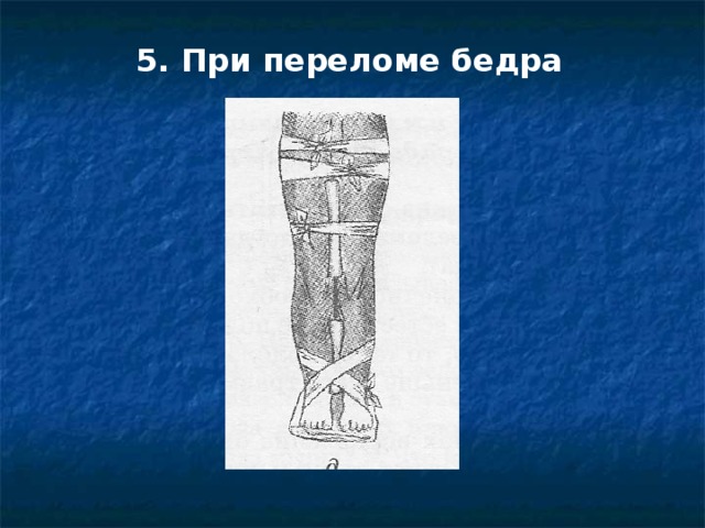 5. При переломе бедра 