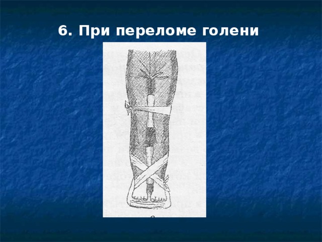 6. При переломе голени 