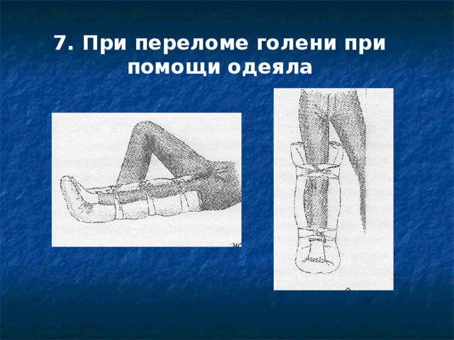 7. При переломе голени при помощи одеяла 