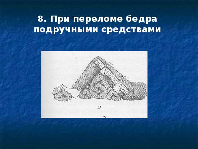 8. При переломе бедра подручными средствами 